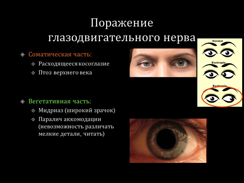 Поражение  глазодвигательного нерва Соматическая часть: Расходящееся косоглазие Птоз верхнего века   Вегетативная
